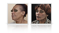 Facelift, neck lift, Bell's palsy.