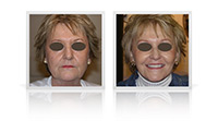 Facelift neck lift, fat transfer to midface.