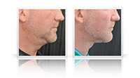 Anterior Neck lift
