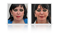 Facelift, Neck lift.
