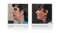 Facelift, Neck lift.
