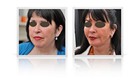 Facelift, Neck lift.
