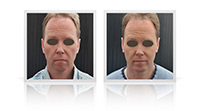 Anterior neck lift, chin implant.