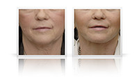 Upper and lower eyelid lift.