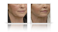 Upper and lower eyelid lift.