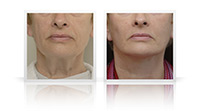 Neck lift, platysma plasty, fat transfer to midface.