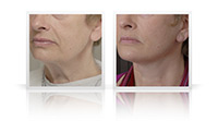 Neck lift, platysma plasty, fat transfer to midface.