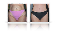 Tummy tuck.
