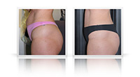Tummy tuck.