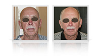 Facelift, Neck lift , neck contouring.