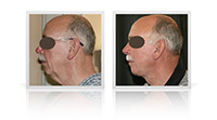 Facelift, Neck lift , neck contouring.