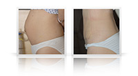 Abdominoplasty umbilical hernia mesh repair.