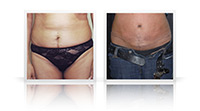 Tummy tuck, diastasis.
