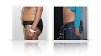 Tummy tuck, diastasis.