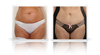 Abdominoplasty, VASER liposelection to flanks.