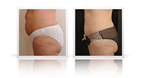 Abdominoplasty, VASER liposelection to flanks.