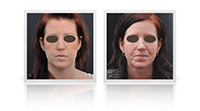 Anterior neck lift