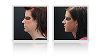 Anterior neck lift