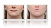 Neck Lift.