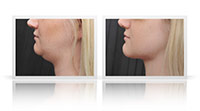 Neck Lift.