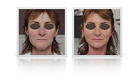 Face and Neck Lift.