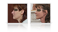 Face and Neck Lift.