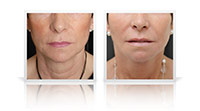 Neck Lift