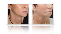 Neck Lift