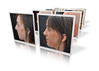 rhinoplasty