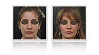 Reduction rhinoplasty for decreased nasal tip and bridge width.
