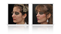 Reduction rhinoplasty for decreased nasal tip and bridge width.