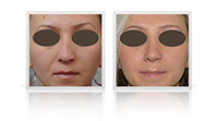 Tertiary open tip rhinoplasty following to primary interventions.