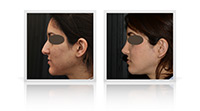 Primary open tip reduction rhinoplasty combined with chin reduction